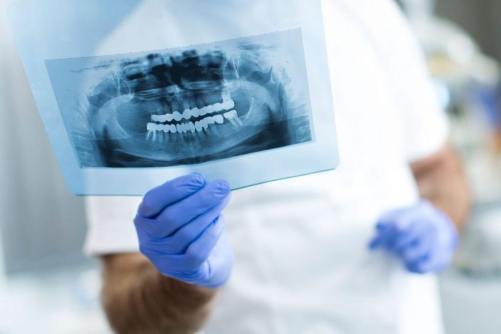 Cirugía guiada ¿Qué es la cirugía guiada para implantes?