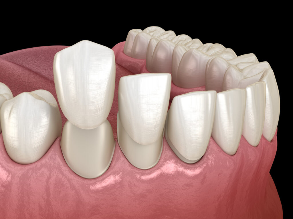 tipos de carillas dentales