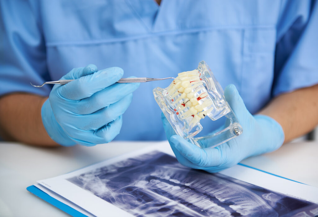implantes dentales sin tornillos