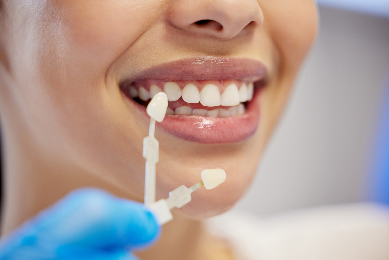 tipos de carillas dentales Carillas dentales: tipos, diferencias y cuál es la mejor opción para ti