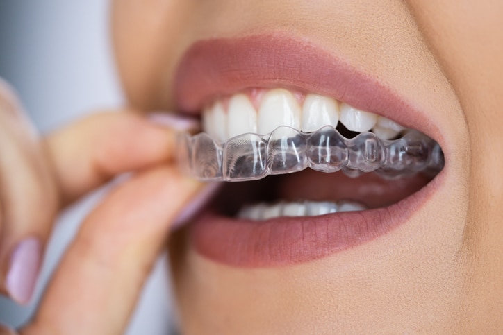 invisalign vs brackets