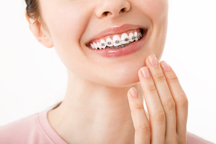 invisalign vs brackets