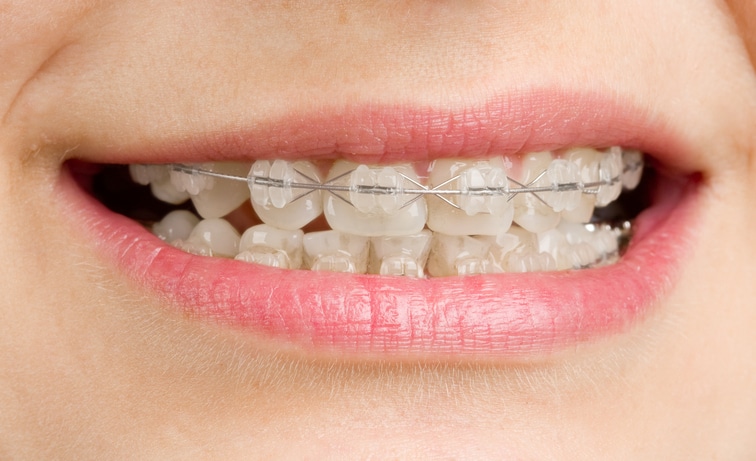 brackets estéticos