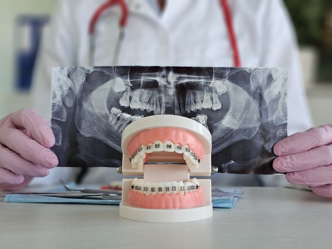 brackets metalicos