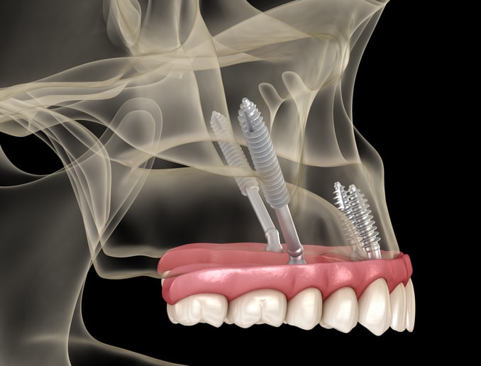 cuánto dura un tratamiento con implantes cigomáticos ¿Cuánto dura un tratamiento con implantes cigomáticos? Cronología paso a paso