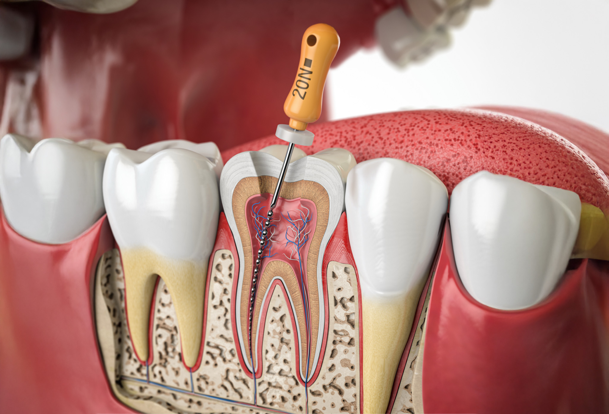 endodoncia_3 endodoncia_3