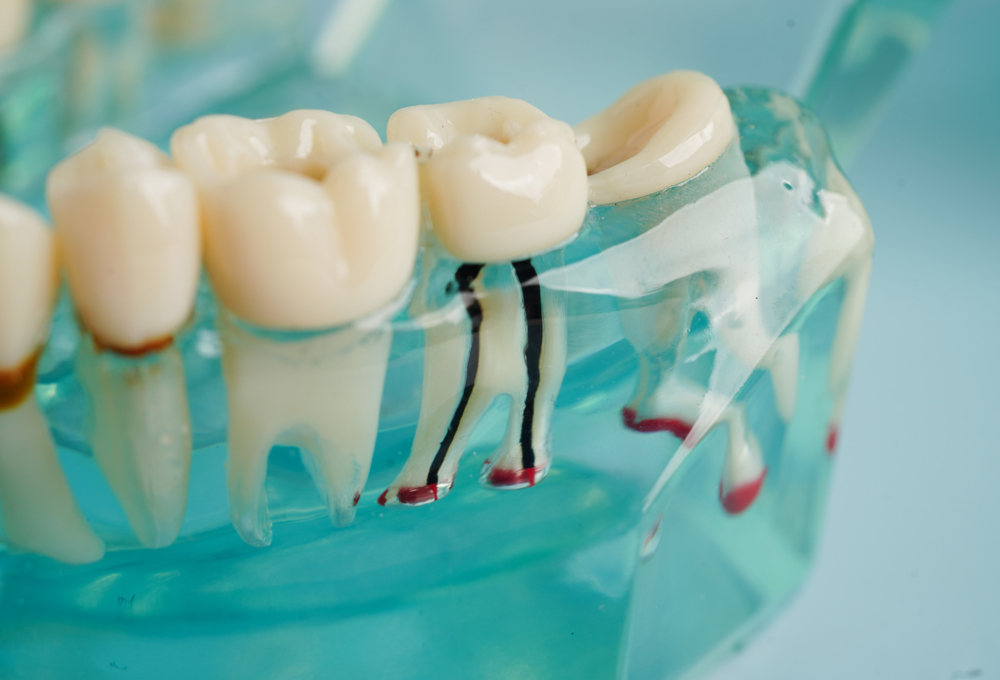 endodoncia_5 endodoncia_5