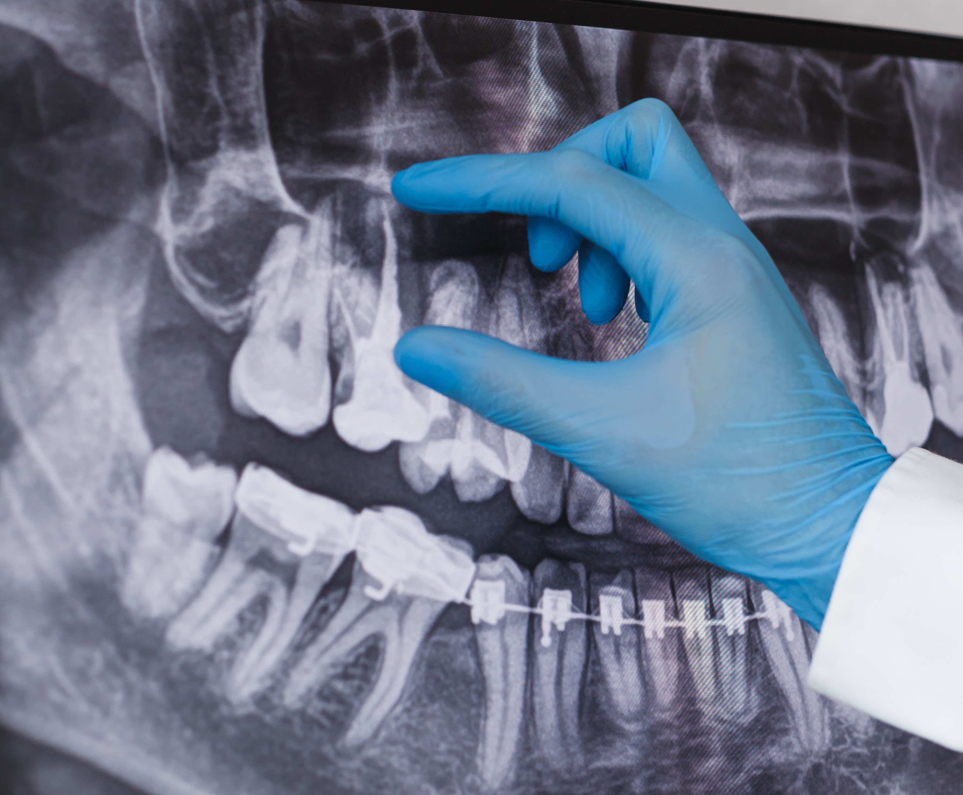 ENDODONCIA ENDODONCIA