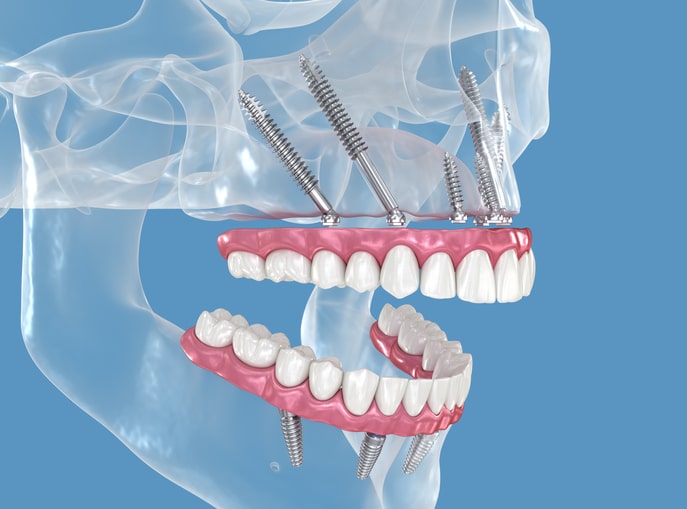 cuanto cuestan los implantes cigomaticos ¿Cuánto cuestan los implantes cigomáticos?
