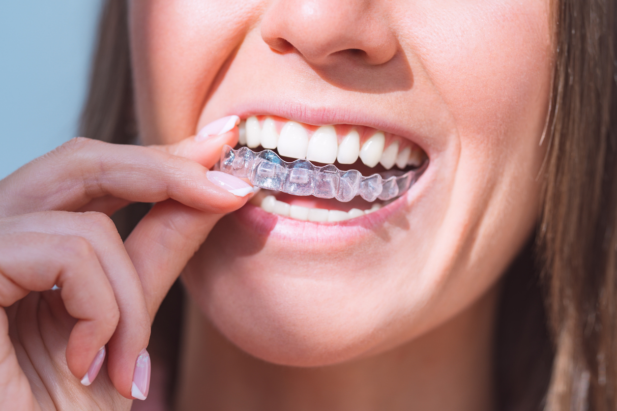 Woman with perfect smile wearing invisible dental aligners for dental correction Woman with perfect smile wearing invisible dental aligners for dental correction
