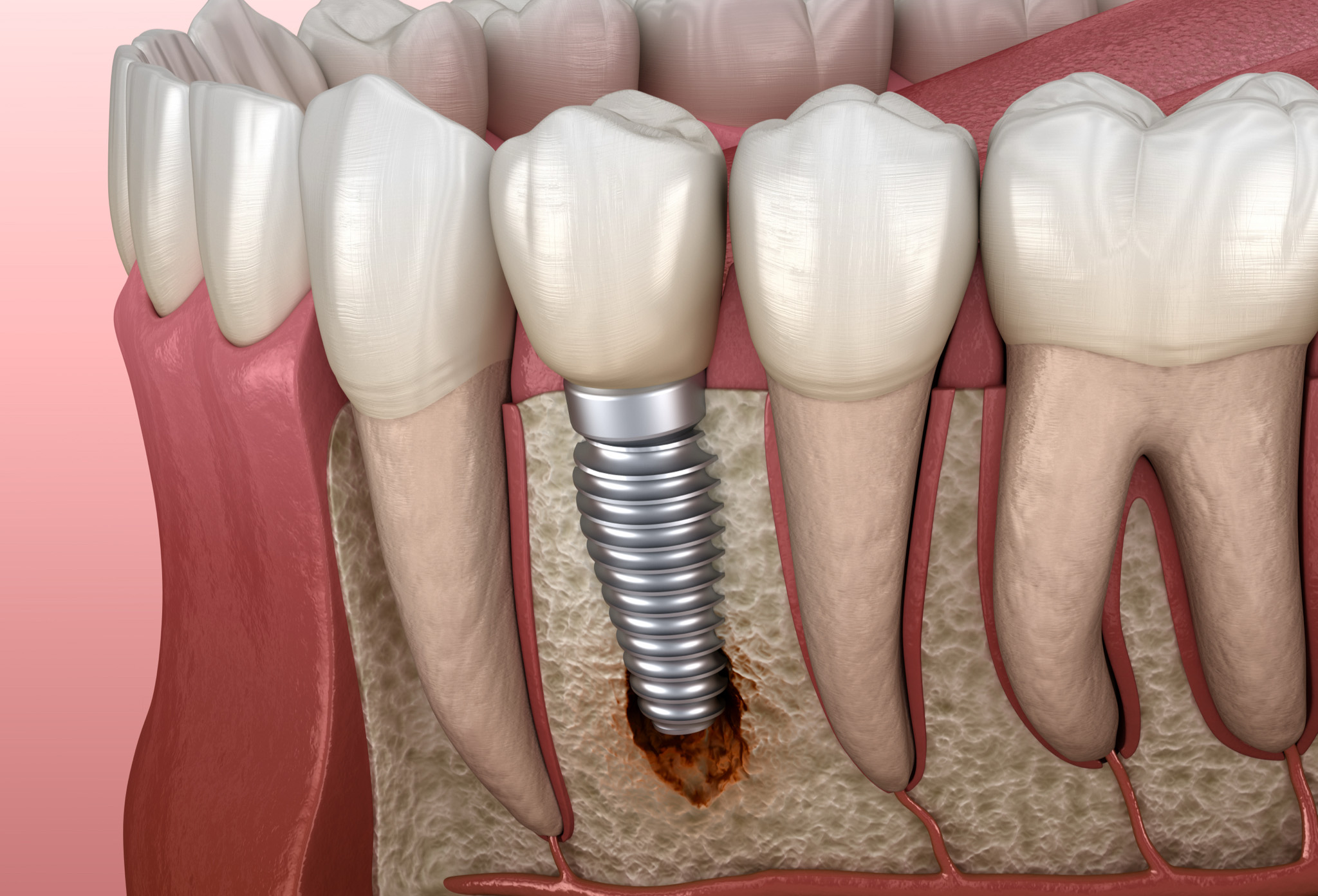 otros_tratamientos_periodoncia_periimplantitis otros_tratamientos_periodoncia_periimplantitis